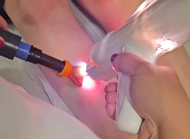 Processo de eliminação de varizes com Laser Transidermico