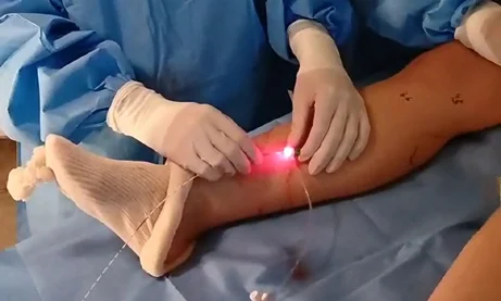 Tratamento para safenas com Endolaser de Veia Safena